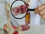 Em 13 anos, doença inflamatória intestinal cresce 5 vezes no Brasil