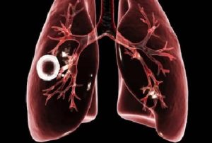 Piauí registra 1.158 casos de tuberculose em 2025 e reforça ações de controle